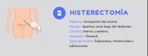 tratamientos para miomas histerectomía