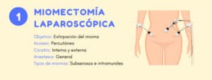 tratamientos para miomas Miomectomía laparoscópica