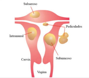 tipos de miomas uterinos