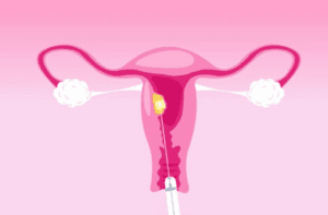Electrodos usado en la radiofrecuencia para miomas radiofrecuencia para miomas