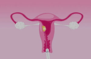 tratamientos para miomas por radiofrecuencia