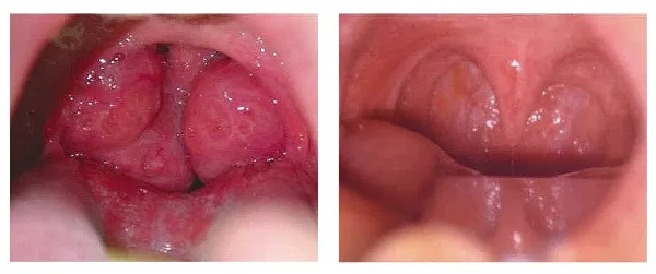 amígdalas pre y post crioablación en orl 