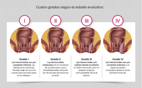 clasificación de las hemorroides